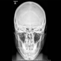 <strong>Schädel-Röntgenbild nach Absturz</strong> <span class=>© Bergluftleben</span>