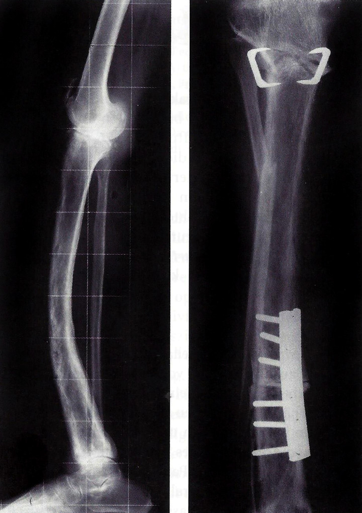 <strong>So in etwa schaute Patricks Schienbeinbruch aus.</strong> <span class=>© Wikipedia</span>